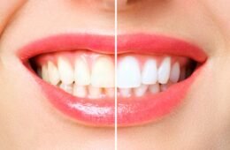 Professional Teeth Whitening: The Secret to a Radiant Smile